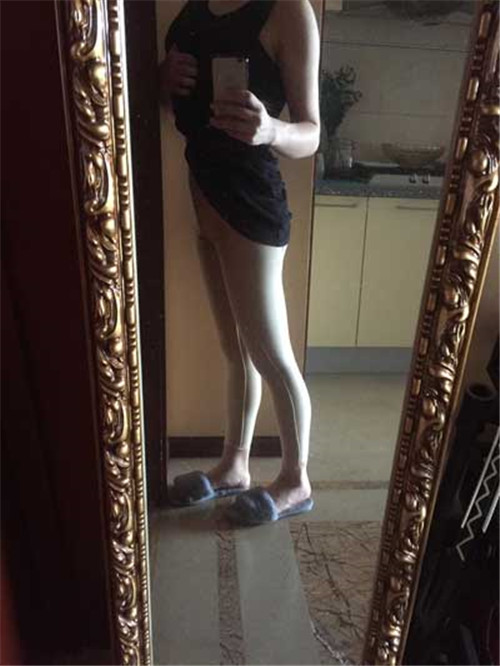 北京禾美嘉任学会抽脂怎么样?案例_价格