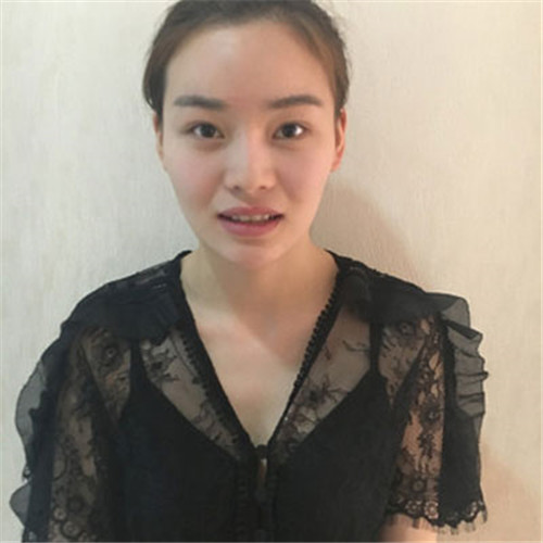 上海华美谢卫国隆鼻怎么样?案例_价格