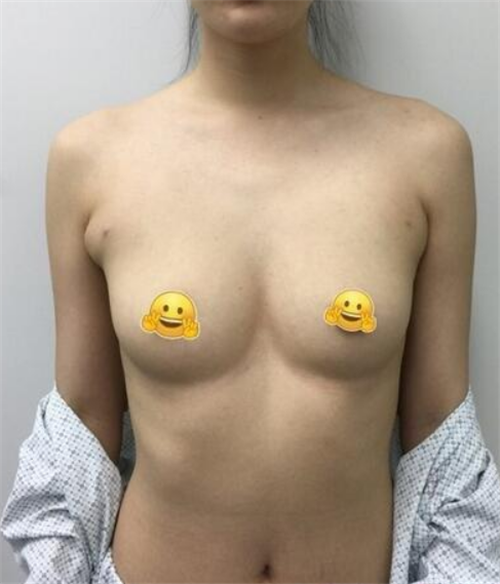 上海玫瑰张东旭隆胸怎么样?案例_价格