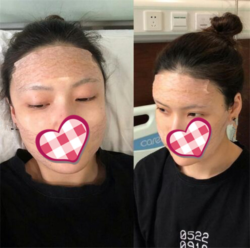 北京联合丽格陈万芳自体脂肪填充怎么样?案例_价格