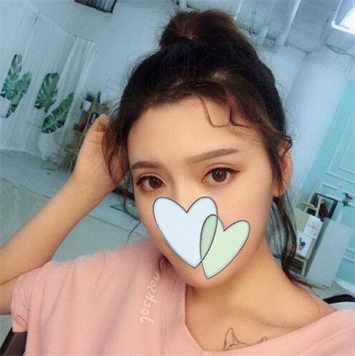 北京联合丽格陈万芳自体脂肪填充怎么样?案例_价格