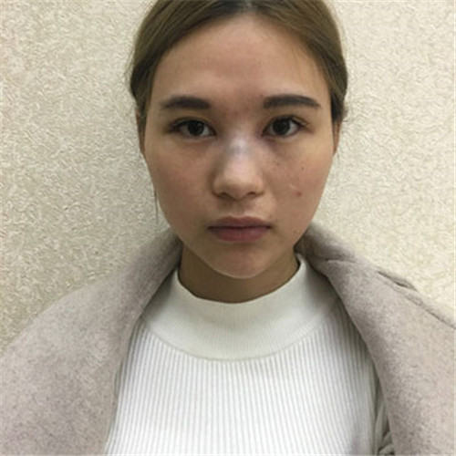 北京美莱王旭东做鼻子怎么样?案例_价格