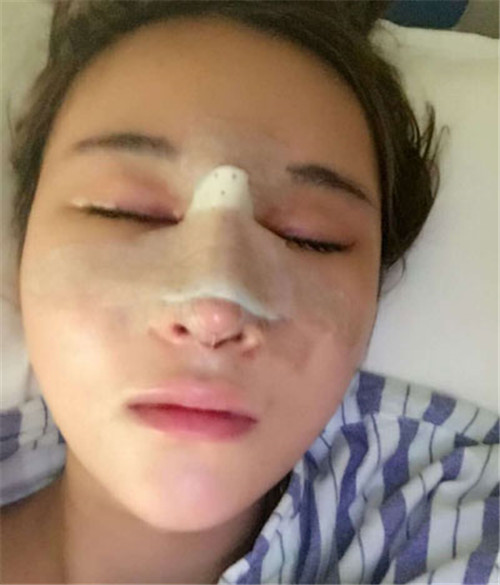 北京美莱王旭东做鼻子怎么样?案例_价格