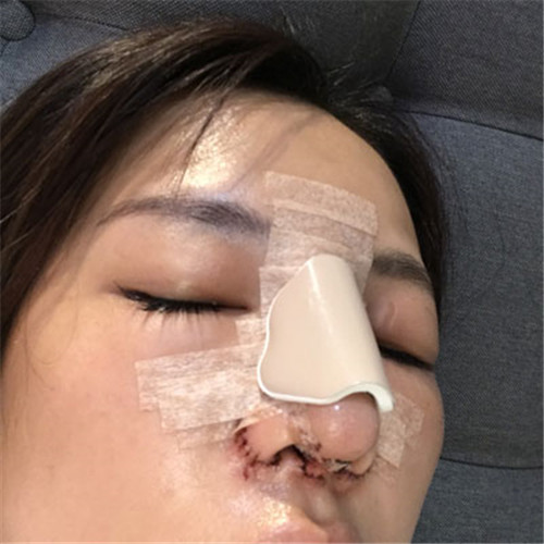 上海天佑王小民隆鼻怎么样?案例_价格