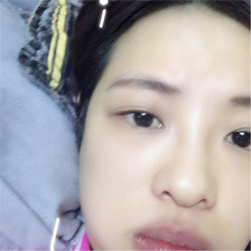 上海天佑王小民隆鼻怎么样?案例_价格