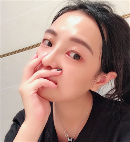 上海天佑王小民隆鼻怎么样?案例_价格