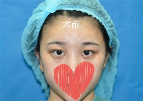 上海艺星许炎龙割双眼皮怎么样?案例_价格