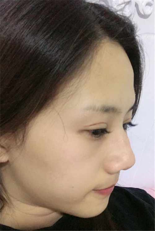 北京联合丽格邢新割双眼皮怎么样?案例_价格