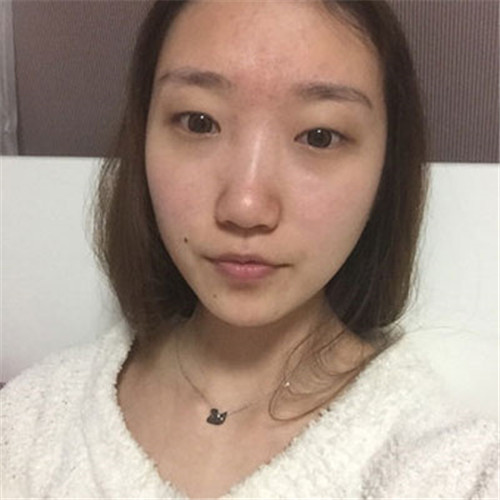 北京知音李文波割双眼皮怎么样?案例_价格