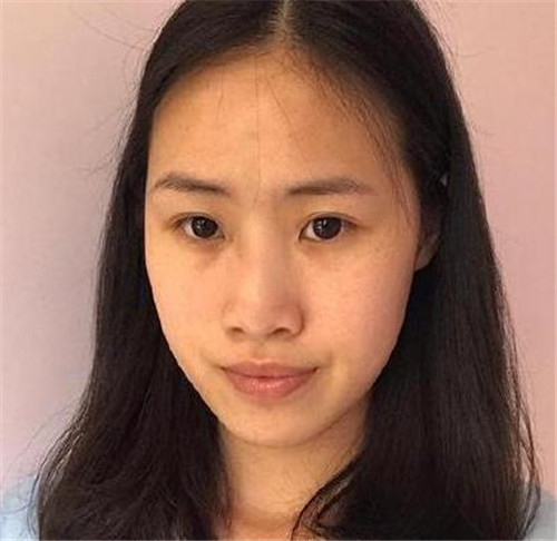 上海华美李健做鼻子怎么样?案例_价格