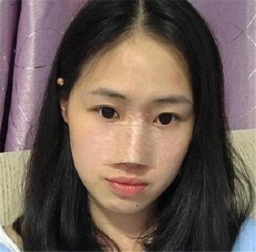 上海华美李健做鼻子怎么样?案例_价格