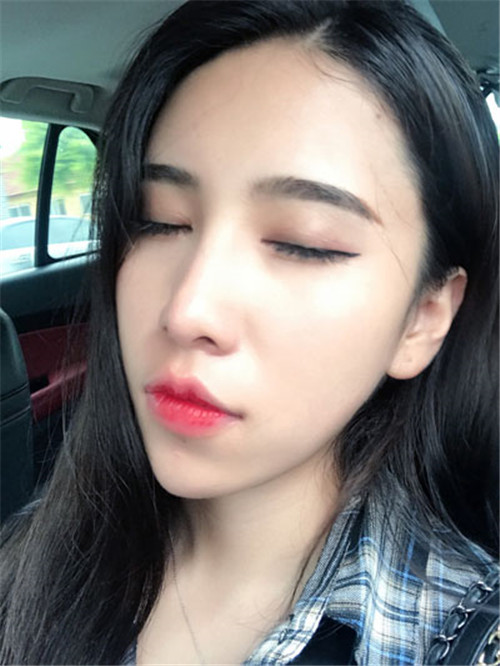 北京联合丽格吴焱秋割双眼皮怎么样?案例_价格