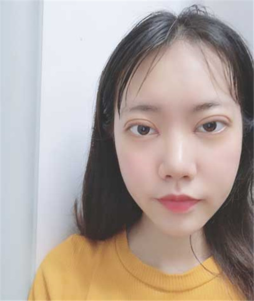 上海华美许再荣割双眼皮怎么样?案例_价格