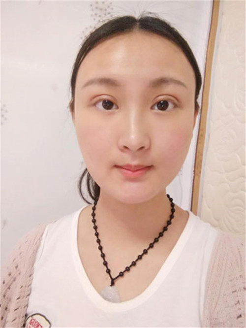 上海容妍杨运华割双眼皮怎么样?案例_价格口碑