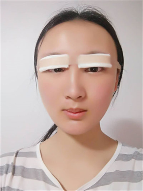 上海容妍杨运华割双眼皮怎么样?案例_价格口碑