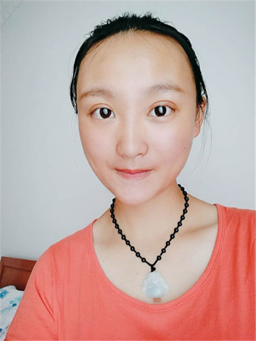 上海容妍杨运华割双眼皮怎么样?案例_价格口碑