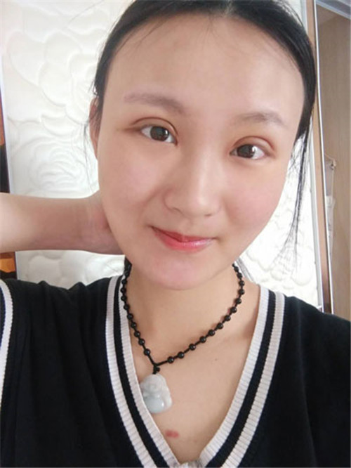 上海容妍杨运华割双眼皮怎么样?案例_价格口碑