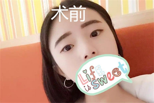 北京壹加壹丁洪如割双眼皮怎么样?案例_价格口碑