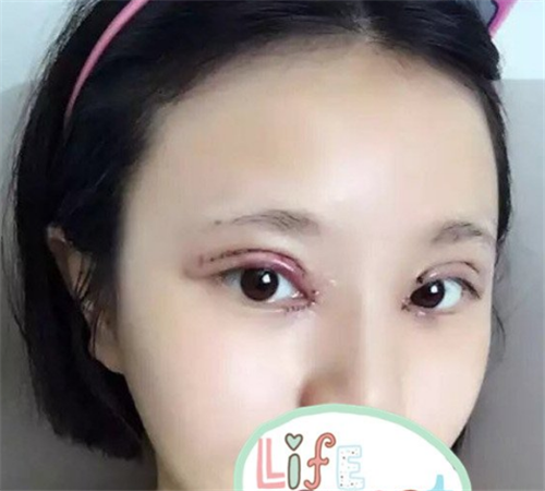 北京壹加壹丁洪如割双眼皮怎么样?案例_价格口碑
