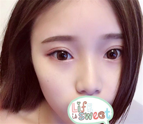 北京壹加壹丁洪如割双眼皮怎么样?案例_价格口碑