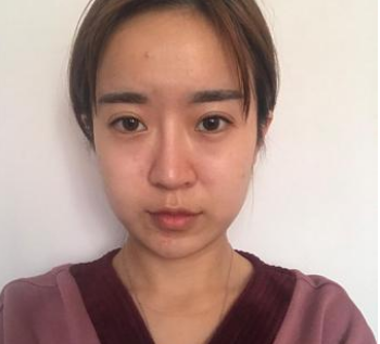 北京玉之光张红芳自体脂肪移植怎么样?案例_价格口碑