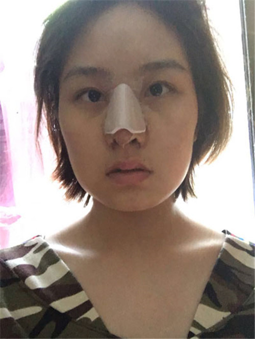 上海德琳段晓光做鼻子怎么样?案例_价格口碑