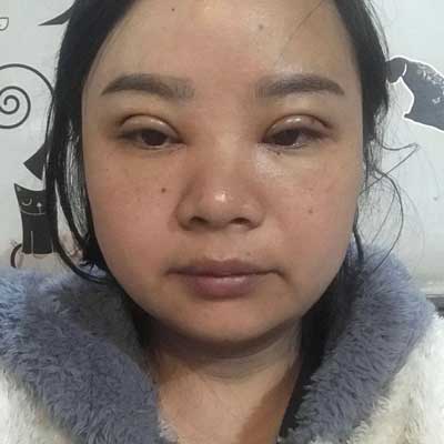 上海艺星杨国正割双眼皮怎么样?案例,价格