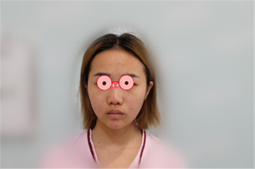 上海艺星许炎龙割双眼皮怎么样?案例,价格
