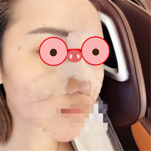 上海艺星许炎龙割双眼皮怎么样?案例,价格