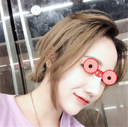 上海艺星许炎龙割双眼皮怎么样?案例,价格