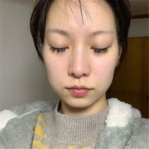 袁玉坤自体脂肪移植怎么样?案例,价格