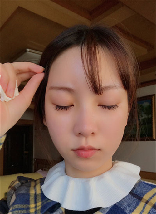 袁玉坤自体脂肪移植怎么样?案例,价格