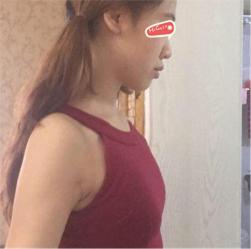 北京伟力嘉美信叶文珏自体脂肪移植怎么样?案例,价格