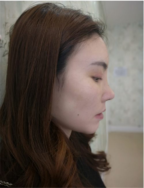 上海德琳段晓光隆鼻怎么样?案例_价格