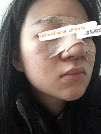 北京柏丽于海军隆鼻怎么样?案例,价格