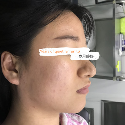 北京柏丽于海军隆鼻怎么样?案例,价格