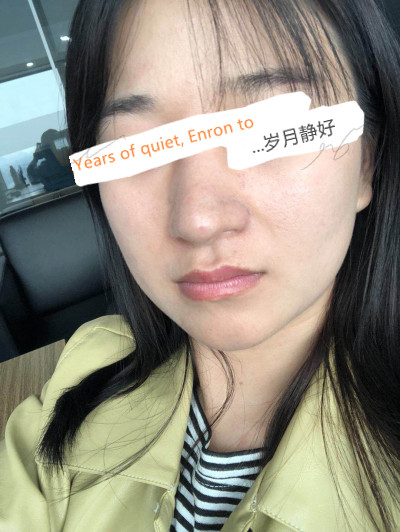 北京柏丽于海军隆鼻怎么样?案例,价格