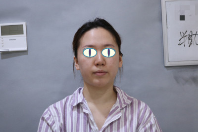 北京鼻祖赵连阁隆鼻怎么样?案例,价格