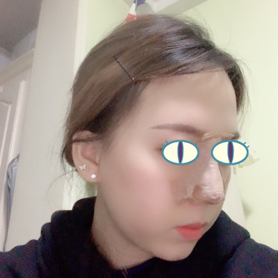 北京鼻祖赵连阁隆鼻怎么样?案例,价格