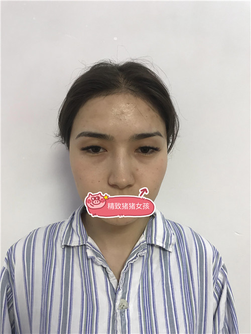 北京丽星翼美魏志香割双眼皮怎么样?案例,价格