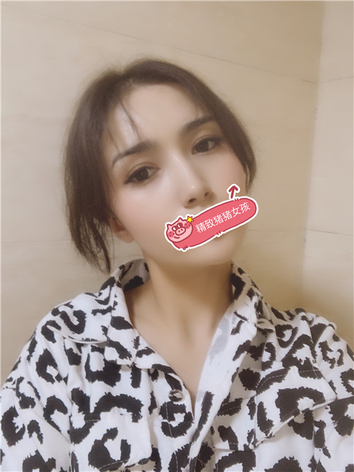 北京丽星翼美魏志香割双眼皮怎么样?案例,价格