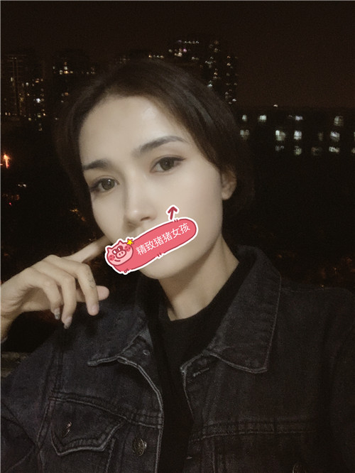 北京丽星翼美魏志香割双眼皮怎么样?案例,价格