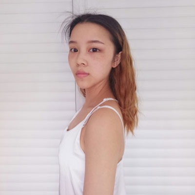 北京禾美嘉韦辉自体脂肪移植怎么样?案例,价格