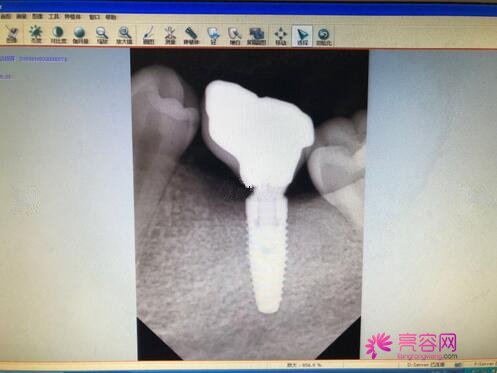 昆明雅度口腔医院怎么样？收费高吗？收费标准|种植牙案例图