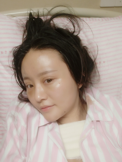 北京联合丽格陈万芳自体脂肪移植怎么样?案例,价格