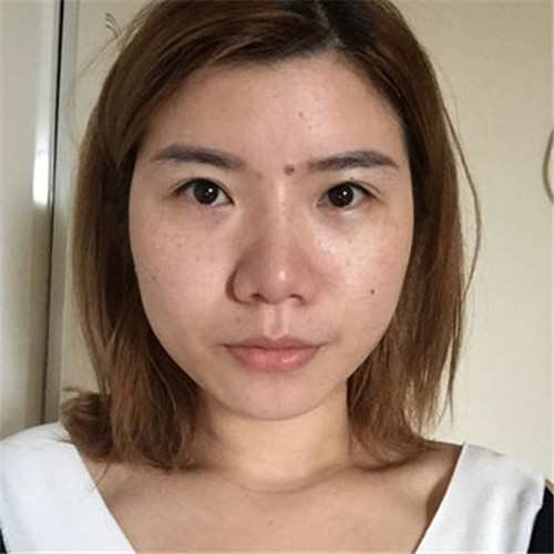 王琳隆鼻怎么样?案例_价格