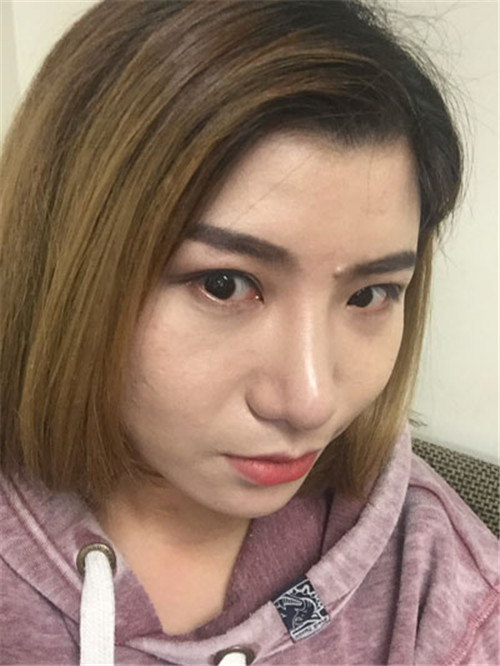 王琳隆鼻怎么样?案例_价格