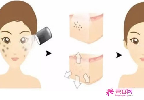 光子嫩肤对皮肤有伤害吗?术后注意事项有哪些
