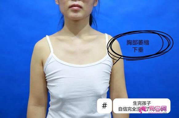 厦门174整形科怎么样？价格,案例,隆胸,口碑