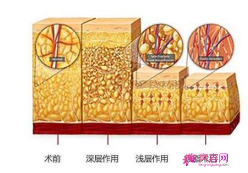 聚能吸脂真的有那么好吗？种种细节透露出好事将近